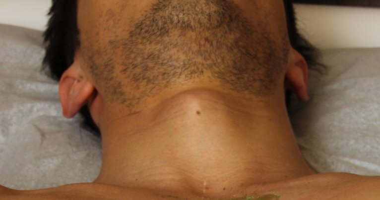 Full Chest with Nipples Hard Wax - Brazilian Waxing Center.Spa Services In  Manhattan NY