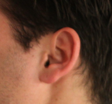 Unisex Ear Laser Hair Removal Treatment